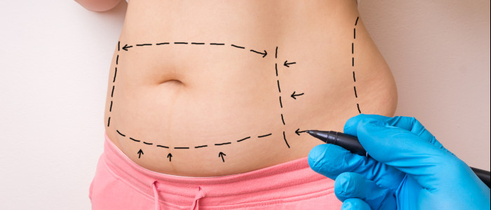 liposukcja Warszawa Szpital Damiana