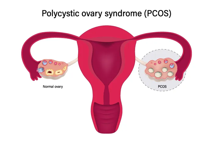 pcos_schemat
