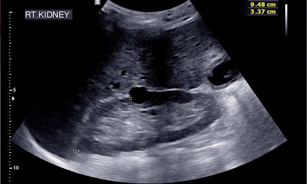 zdjecie z&nbsp;badania usg układu moczowego pacjenta
