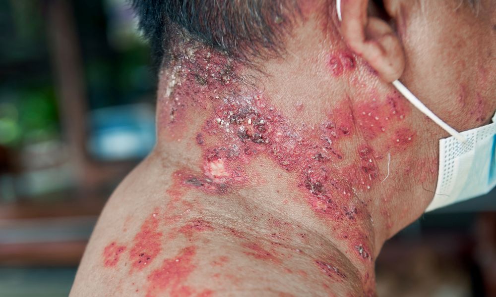 p&oacute;łasiec na karku i&nbsp;szyi