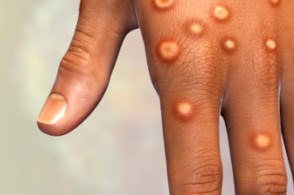 Małpia ospa – czym jest? Jak rozpoznać objawy? Jak uniknąć zakażenia wirusem?