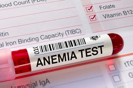 Anemia – objawy i&nbsp;leczenie. Przyczyny niedokrwistości