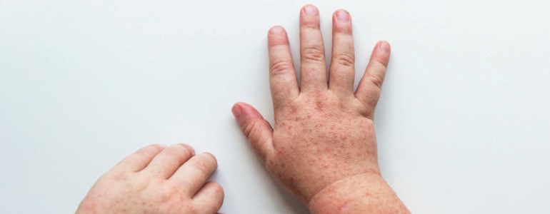 szkarlatyna przyczyny objawy