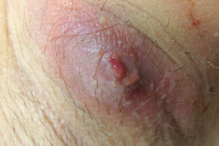 Czym jest czyrak? Przyczyny powstawania, objawy i&nbsp;leczenie zapalenia mieszka włosowego