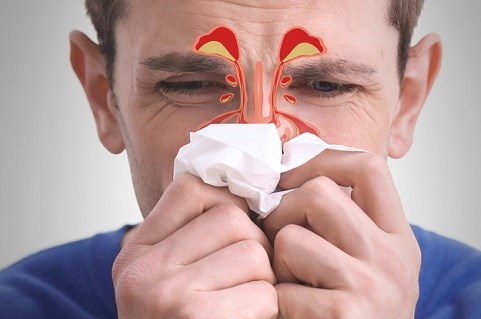 Ból zatok, zapalenie zatok – przyczyny, objawy i&nbsp;leczenie. Jak dbać o&nbsp;zatoki?