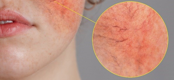 Trądzik różowaty to przewlekła choroba zapalna skóry twarzy.
