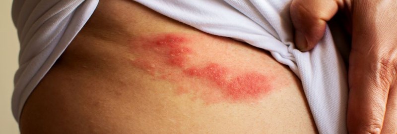 Półpasiec – objawy, które warto znać. Jak go rozpoznać i&nbsp;skutecznie leczyć?