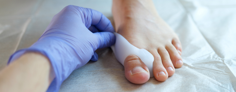 Haluksy - wczesne objawy i&nbsp;leczenie paluchów koślawych