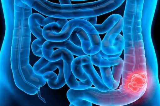 Przyczyny raka jelita grubego: czynniki genetyczne i&nbsp;środowiskowe